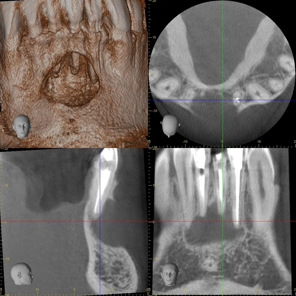 It&rsquo;s amazing what 6 months of adequate endodontic treatment can do&hellip; heals the bone, comforts the pain and saves the teeth. It&rsquo;s a blessing to be practicing in this time and age and deliver this kind of high-level service to our pat