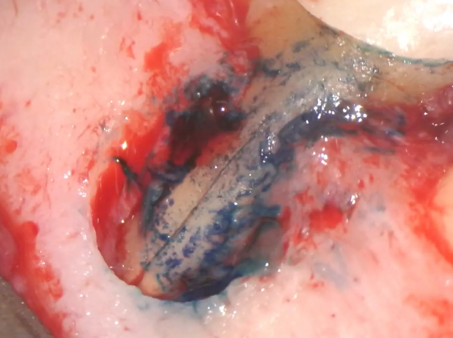 Vertical root fractures are my worst enemy!!