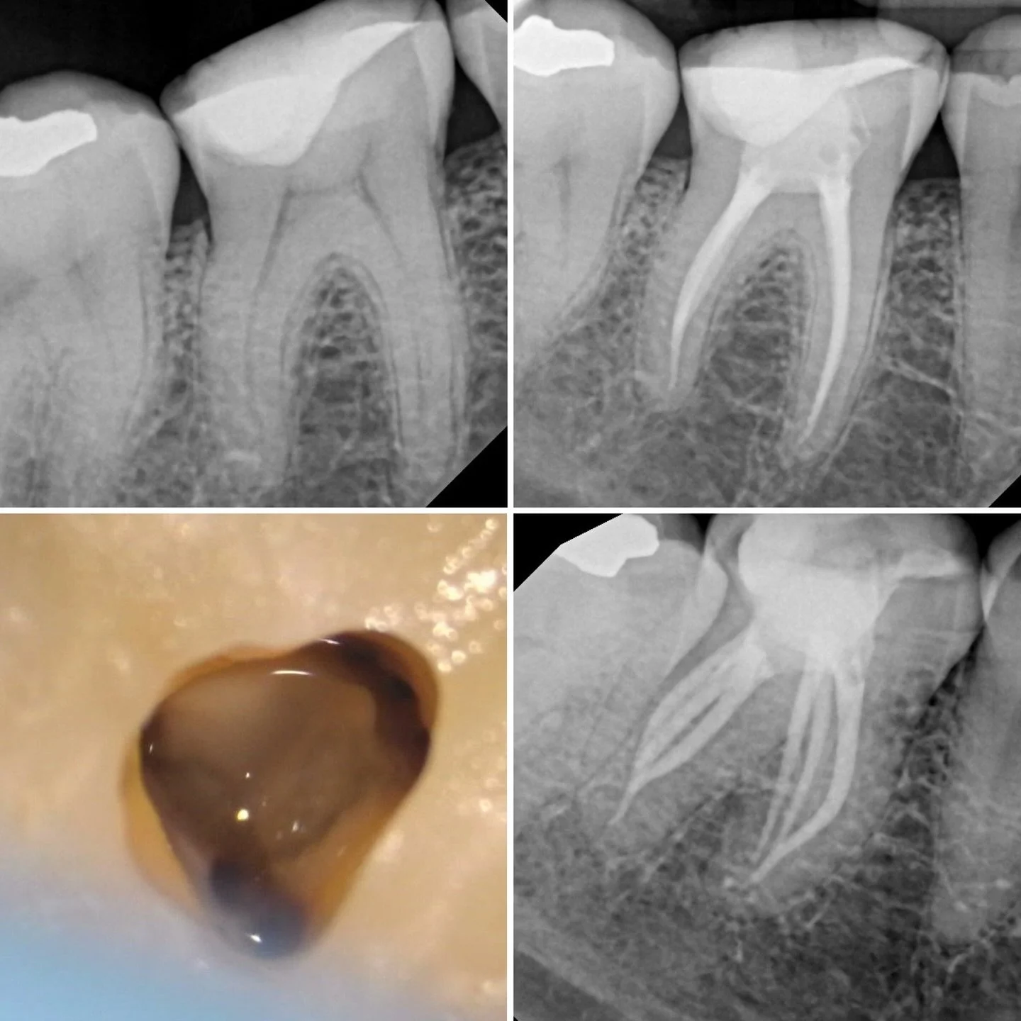 Cool case with 6️⃣ canals I posted a reel of recently&hellip;. Munce burs and conservative instrumentation for the win 🦷🦷