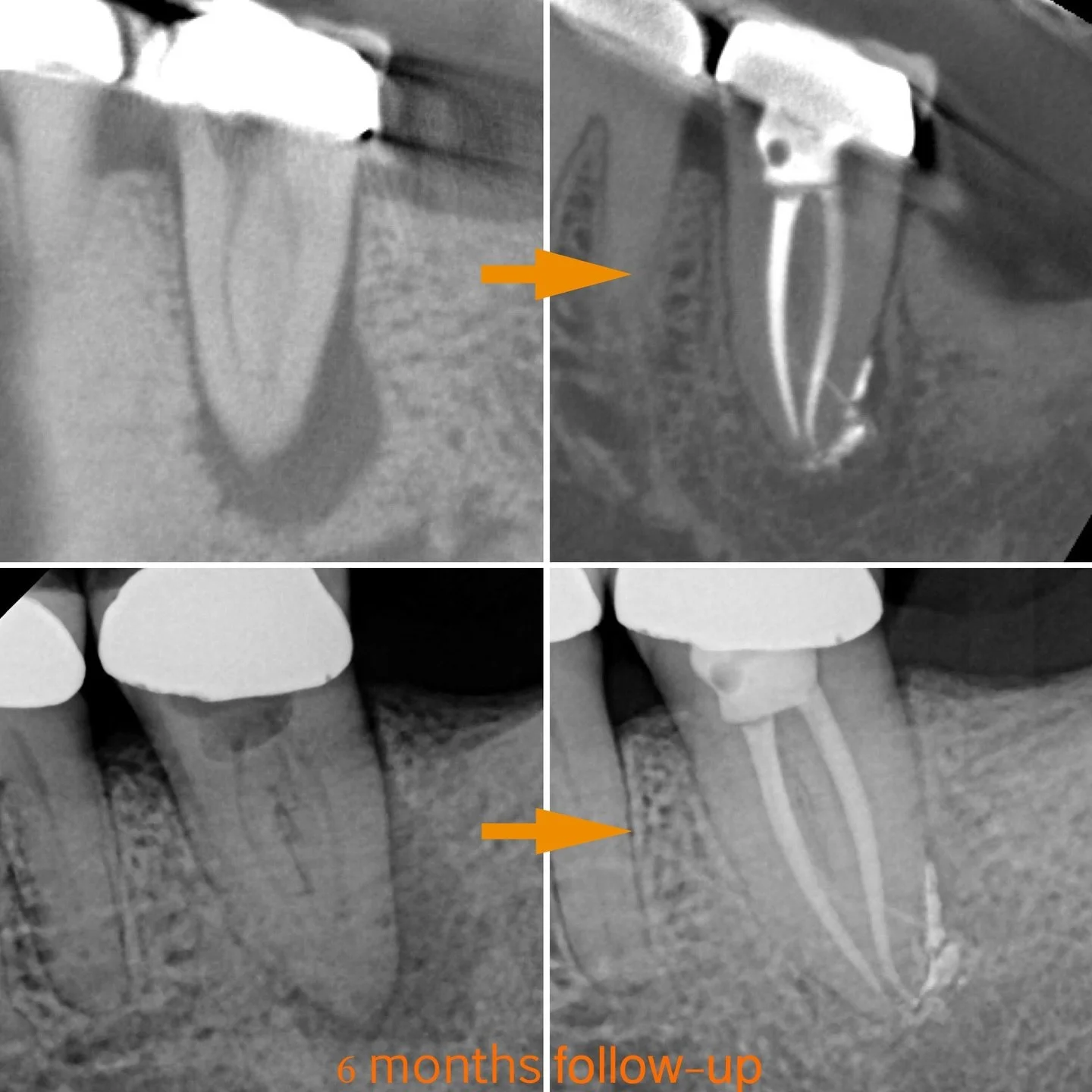 Love these 6 months amazing healing follow-ups 🦷 This one was previously initiated by the referring dentist, calcified canals and a large lesion. Couldn&rsquo;t be more pleased with the follow-up 😊