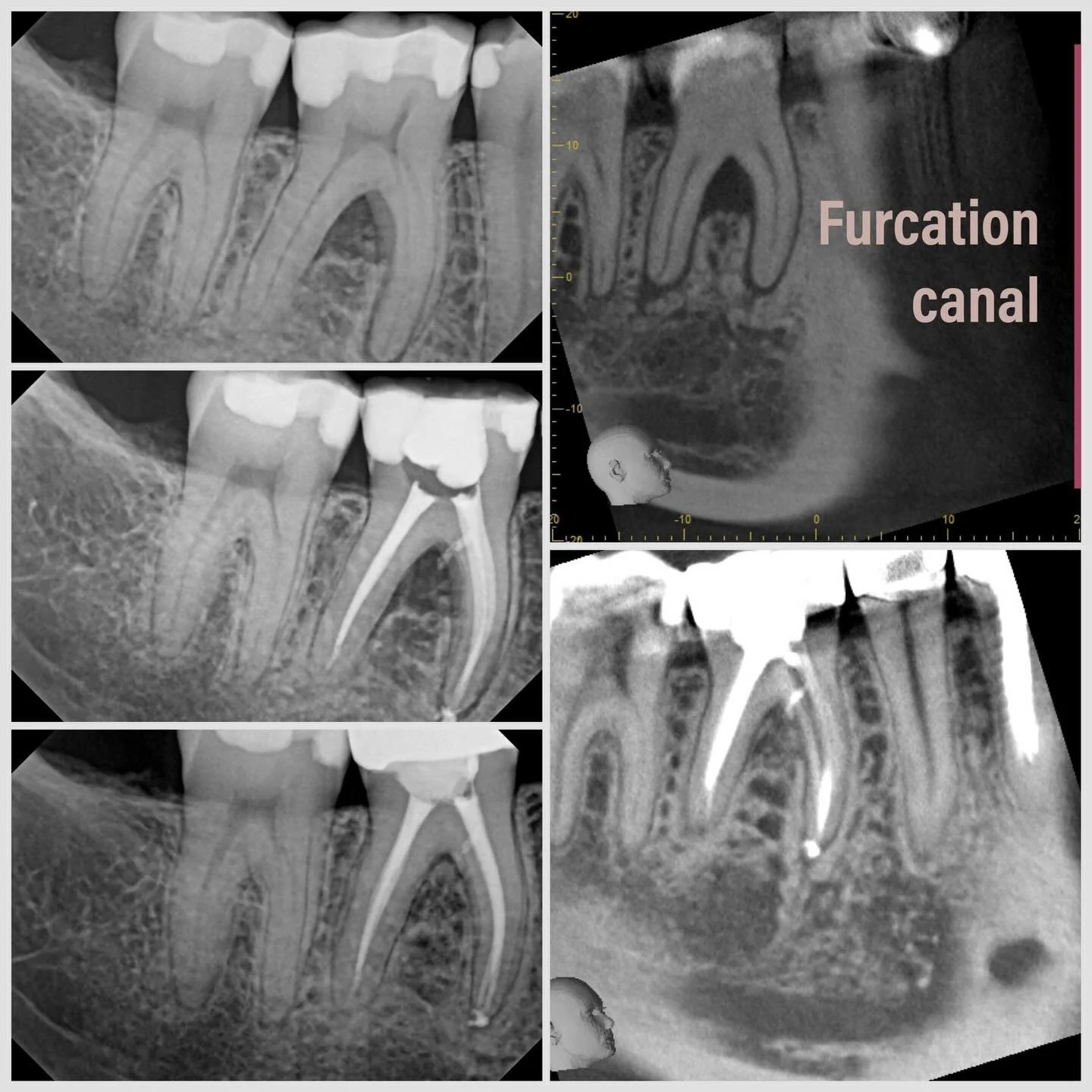 6 months on a furcation canal healing 👌🏼👌🏼👌🏼