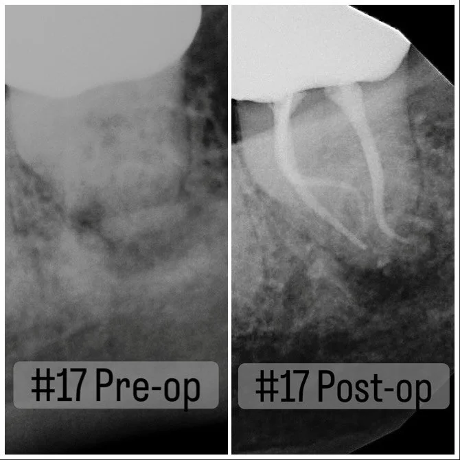 This might be my record: 102 year old patient who is adamant on saving his in occlusion wisdom tooth :) No CT available and the PA was not much help either.. had to go old school tactile sensation and couldn&rsquo;t be happier with the result. Now it