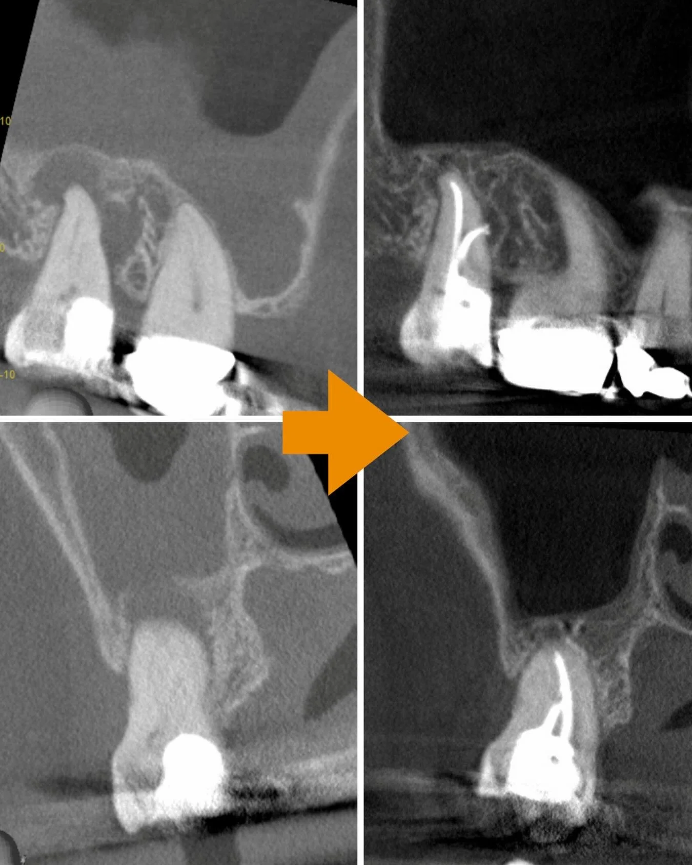 Amazing what six months of adequate endodontic management can do to the tooth and the sinus. Crazy canal exits laterally 💛💛💛