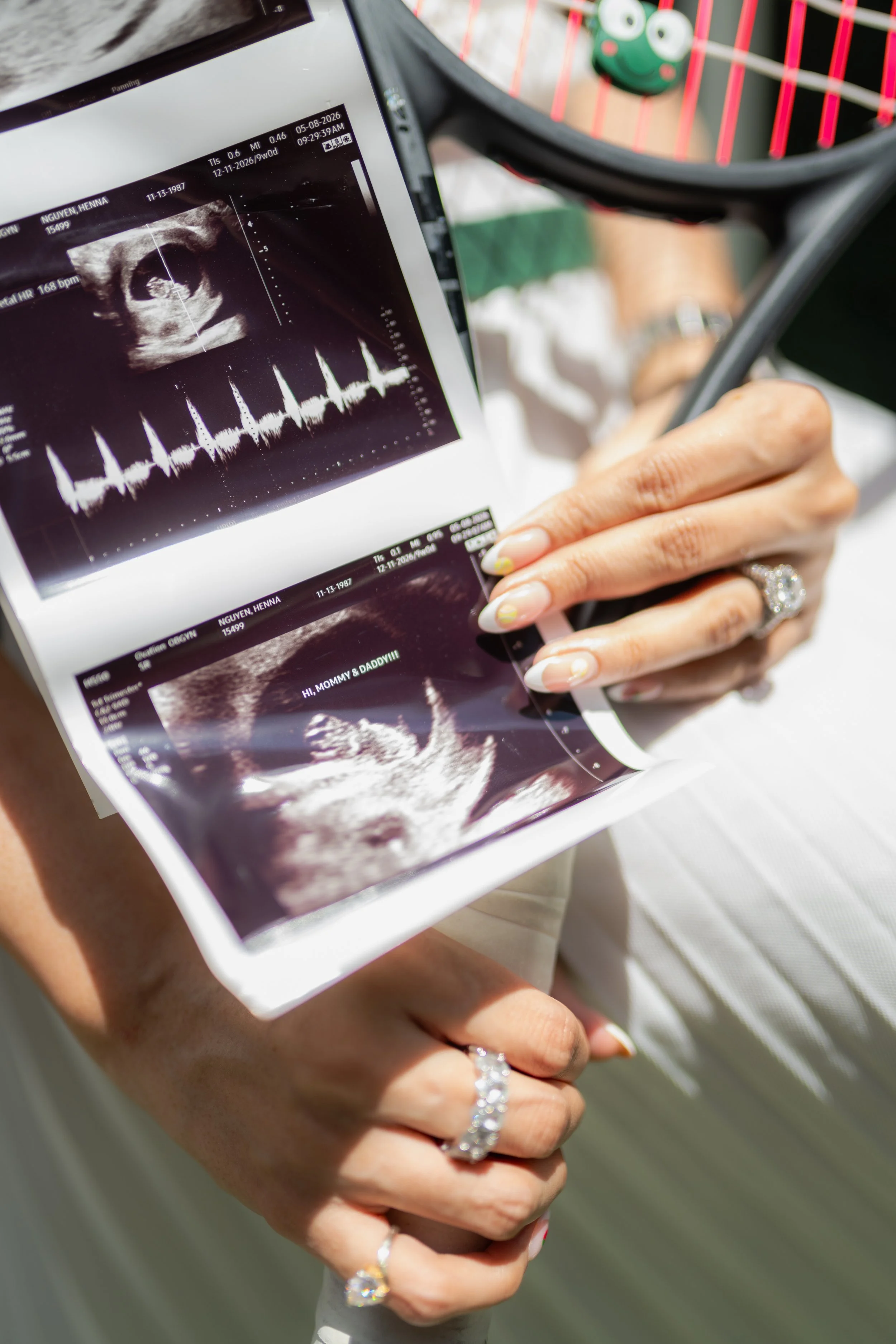Close-up of a person's hand holding an ultrasound image of a fetus, with the person's other hand gently supporting the ultrasound image. The person is wearing rings and has manicured nails with yellow and white nail polish. The background includes pa
