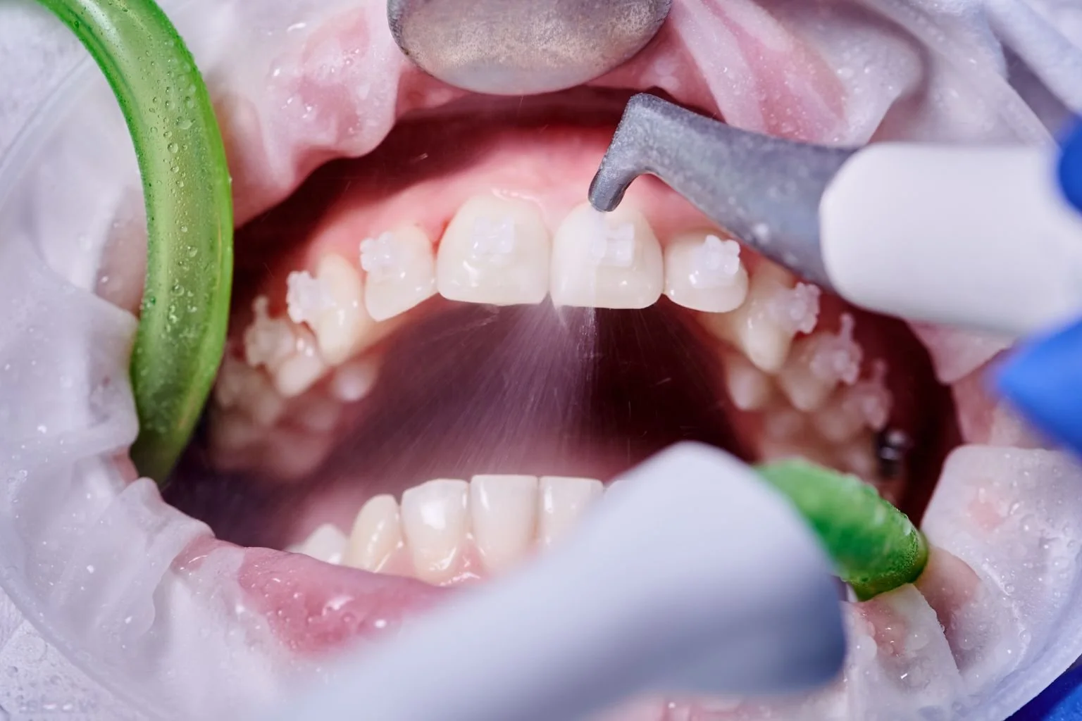 Dental Cleaning Services in Brampton: Cost, Procedure &amp; Insurance Coverage 