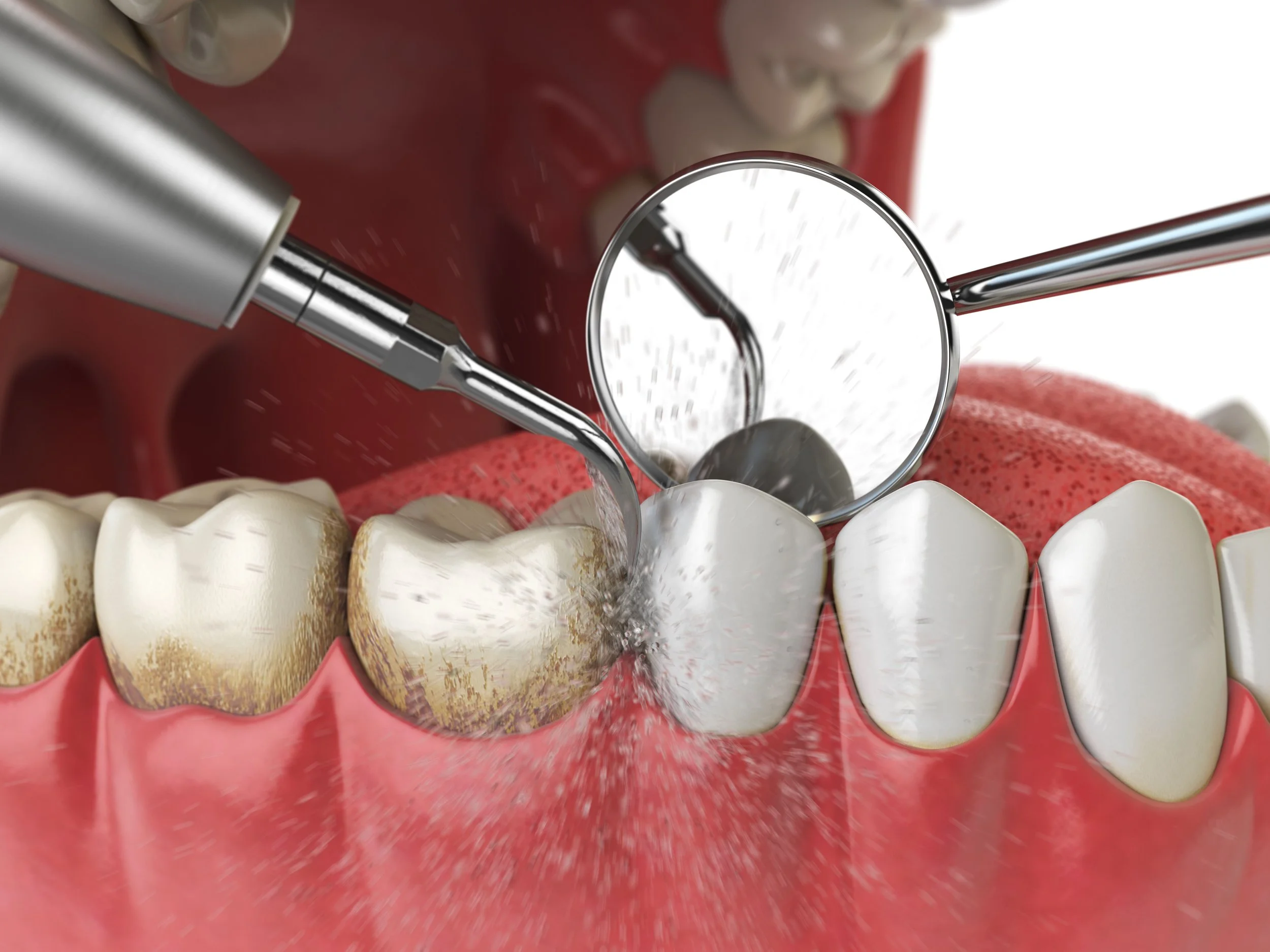 Dental Cleanings Services