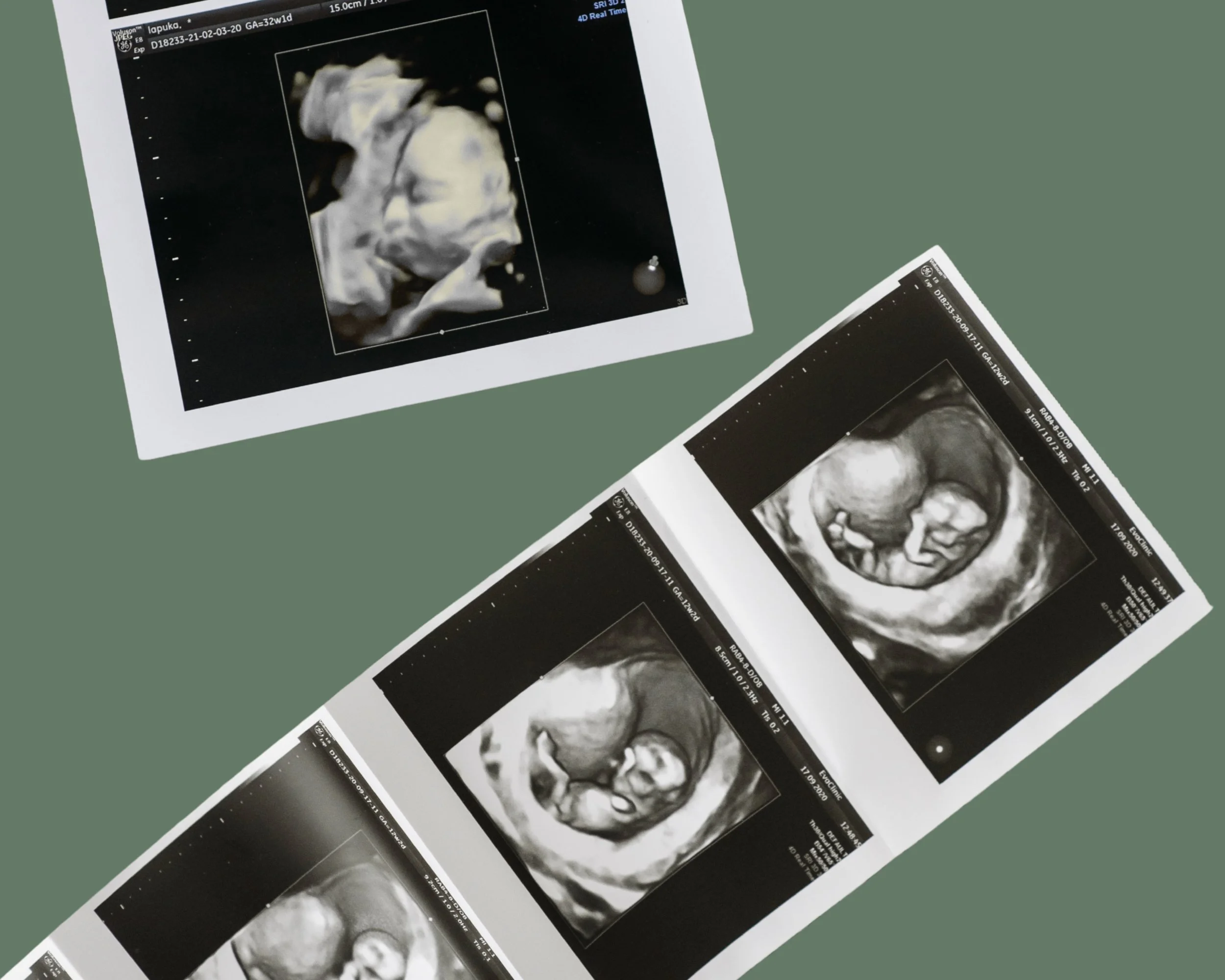 Schallbilder von Ultraschall-Untersuchungen eines Embryos