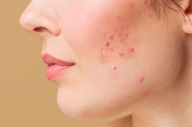 The Benefits of Red Light Therapy for Acne