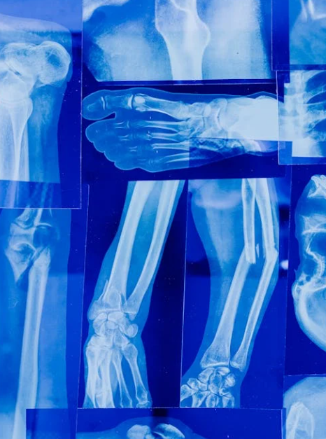 Can Red Light Therapy Accelerate the Healing of Broken Bones?