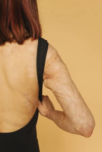 Red Light Therapy to Minimize Burn Scars