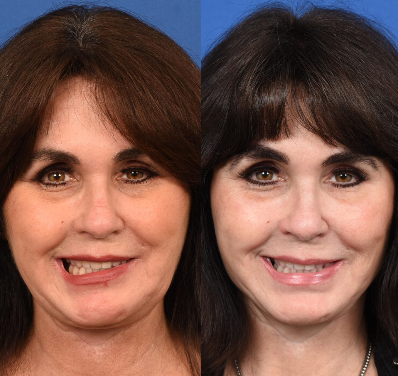 Scientific Research of Red Light Therapy for Bell’s Palsy