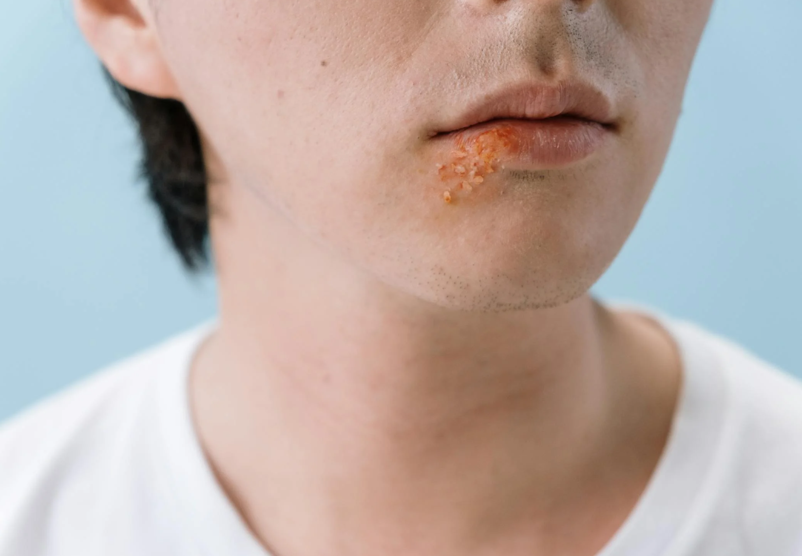 Red Light Therapy for Cold Sores