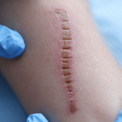 Red Light Therapy for Wound Healing