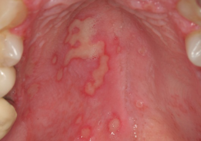 Red Light Therapy for Oral Mucositis