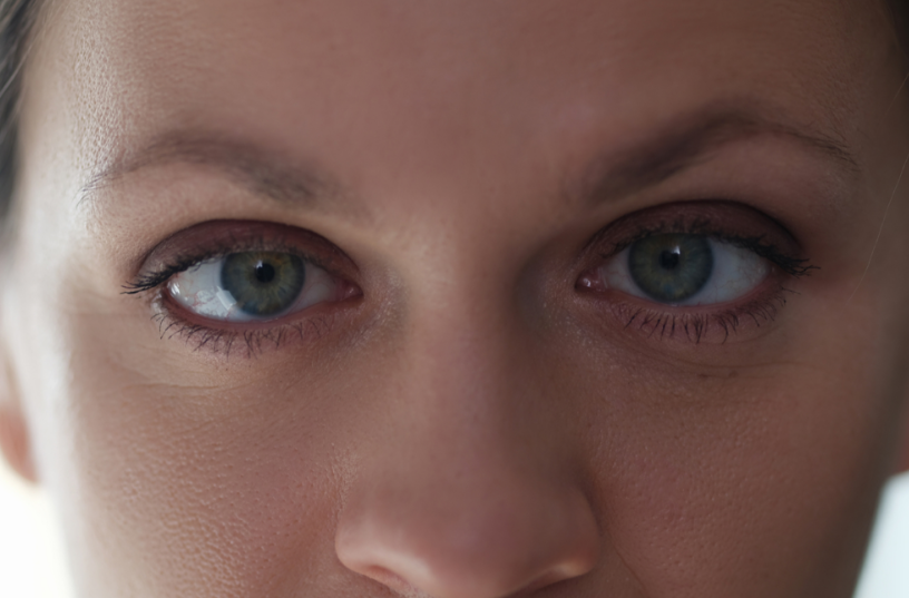 Red Light Therapy for Amblyopia