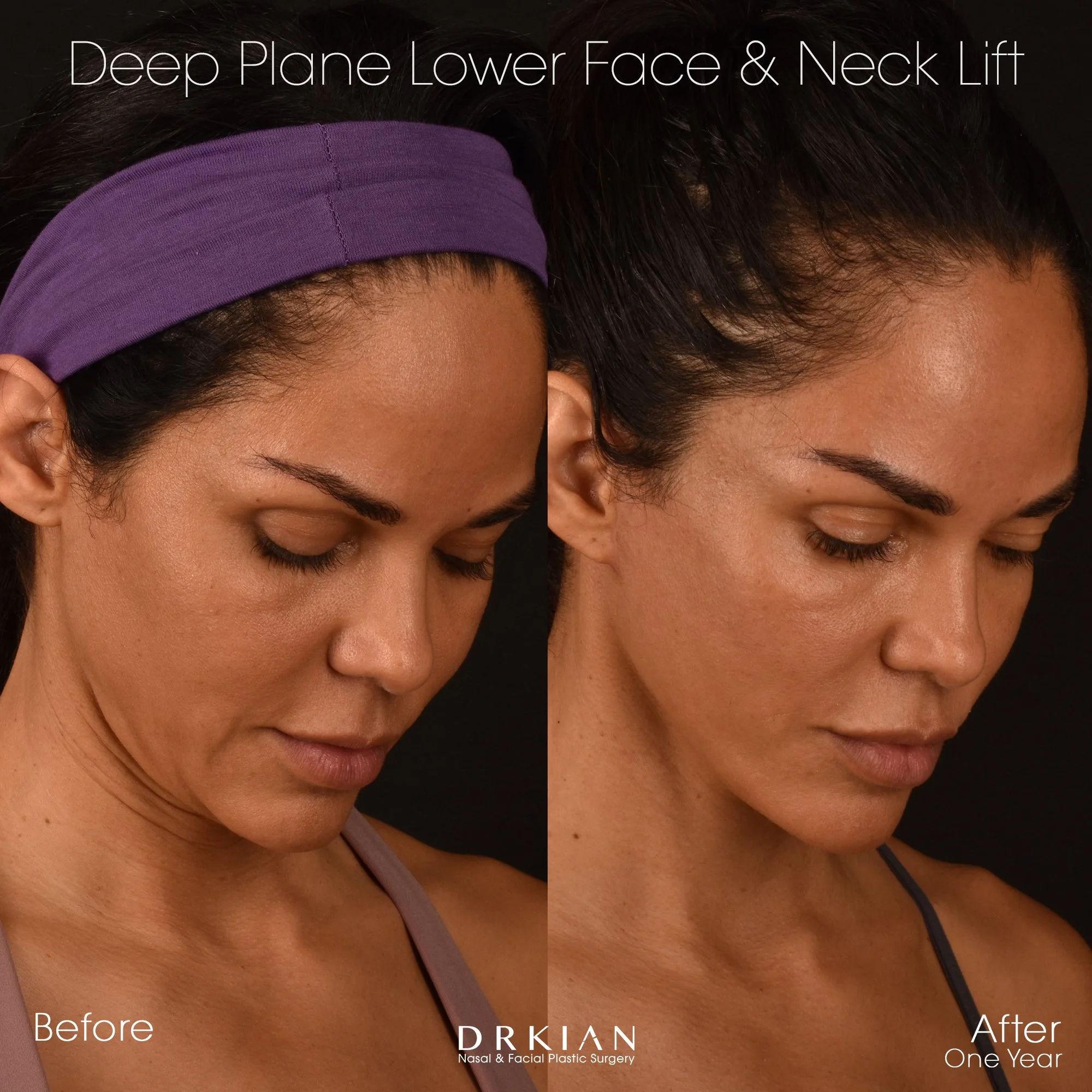 Lower face and neck lift before and after – Dr. Kian Karimi patient