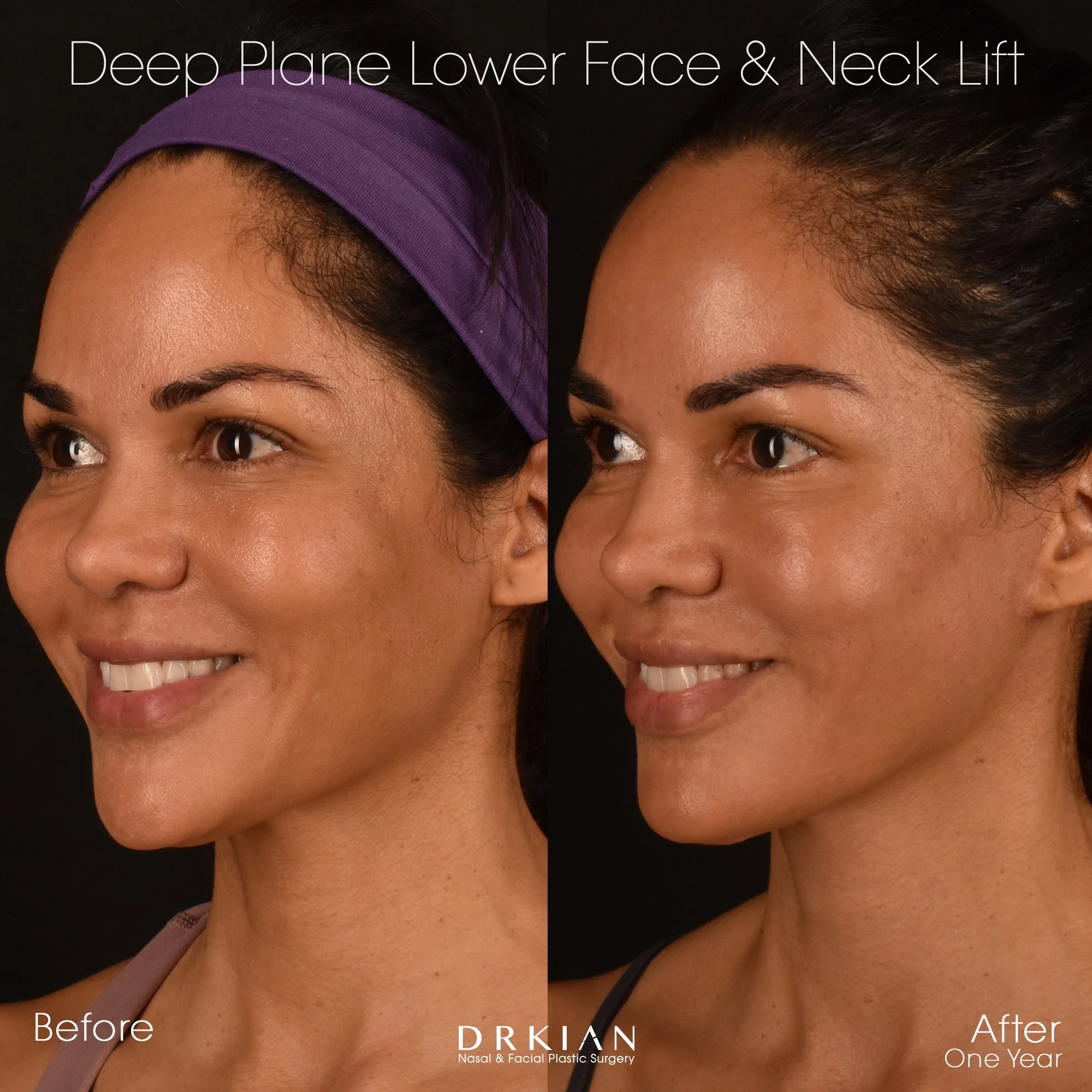 Best facelift results in 40s – patient of Dr. Kian Karimi