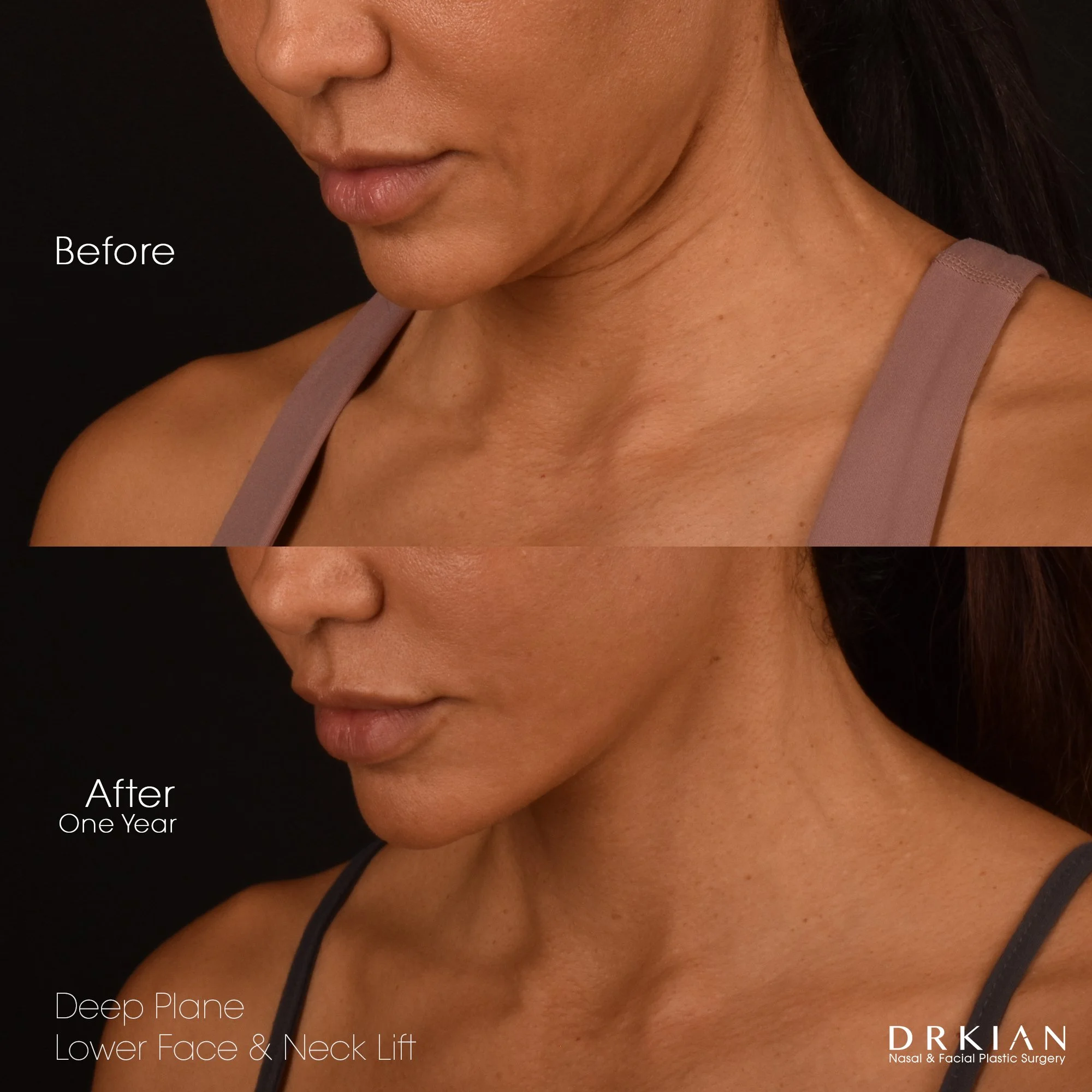 Lower face and neck lift before and after – Dr. Kian Karimi patient