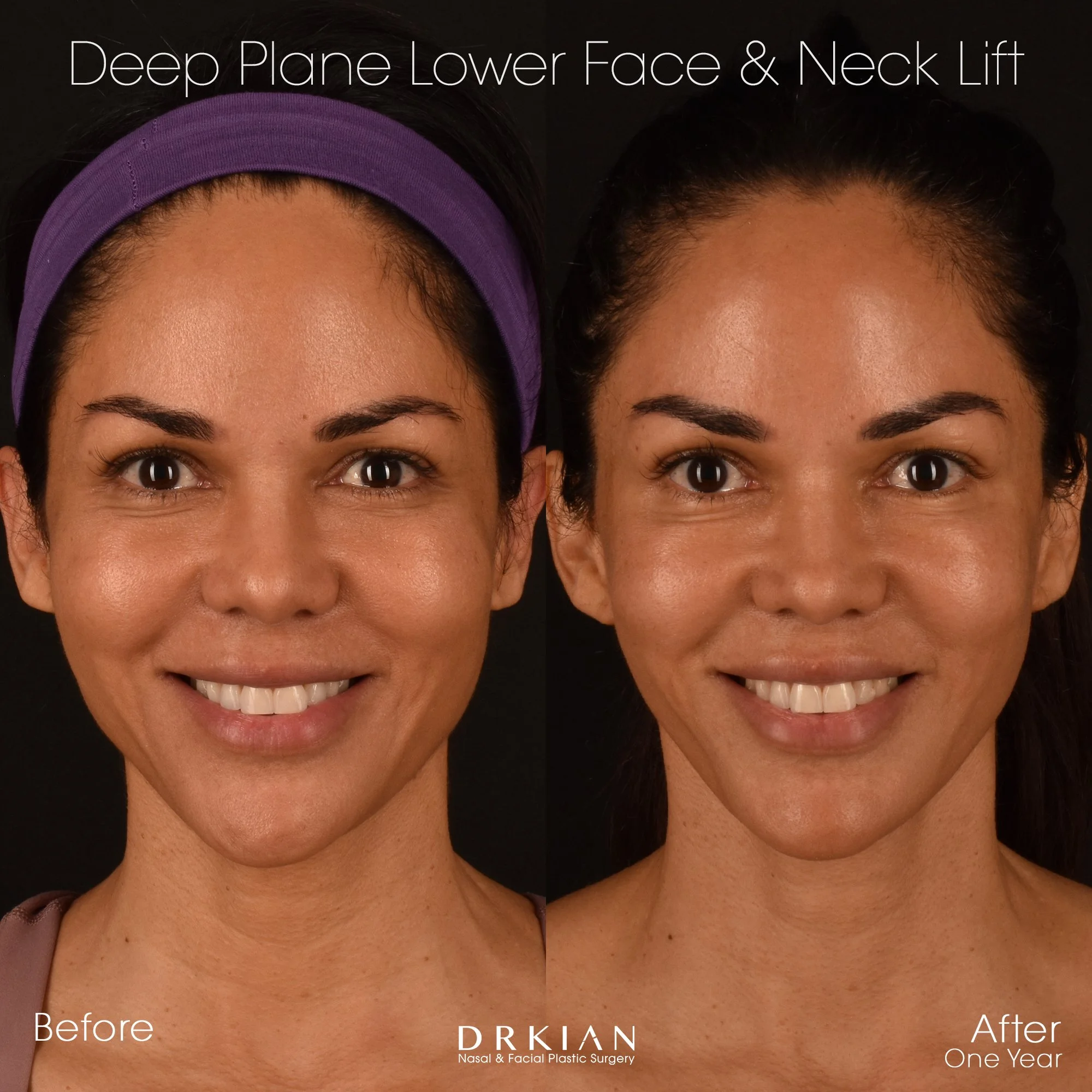 Deep plane facelift before and after in 40s female – Beverly Hills