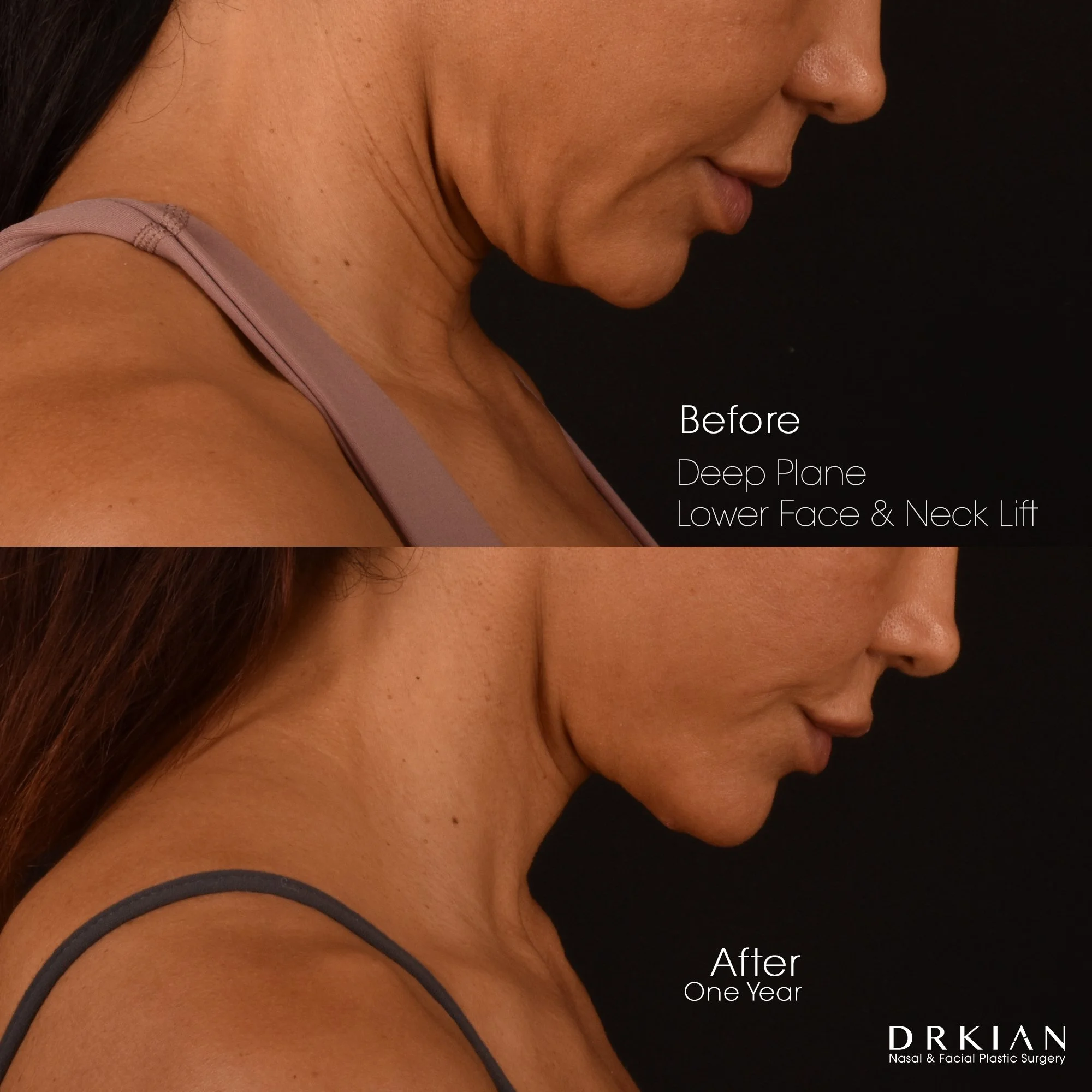 Lower face and neck lift before and after – Dr. Kian Karimi patient