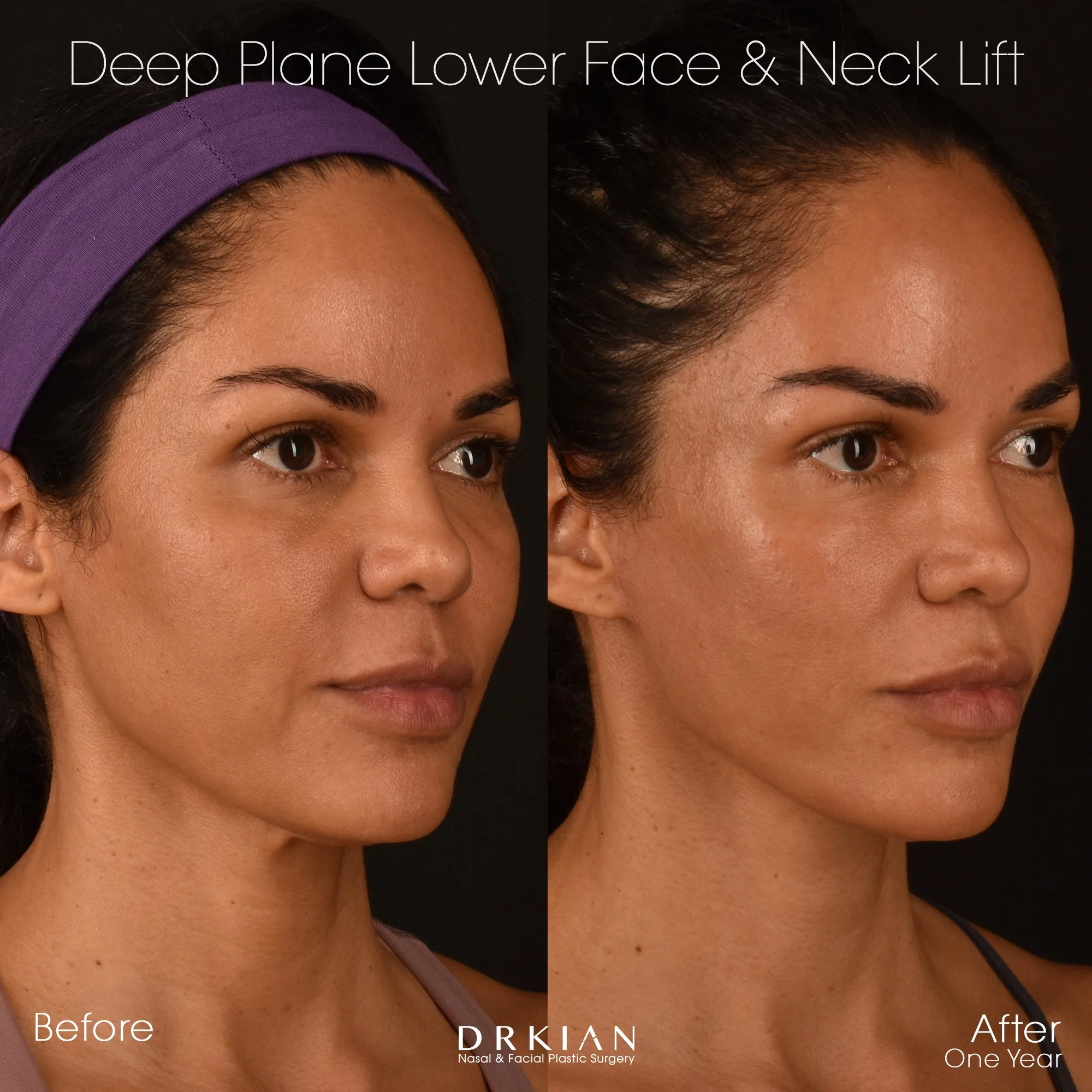 Best facelift results in 40s – patient of Dr. Kian Karimi