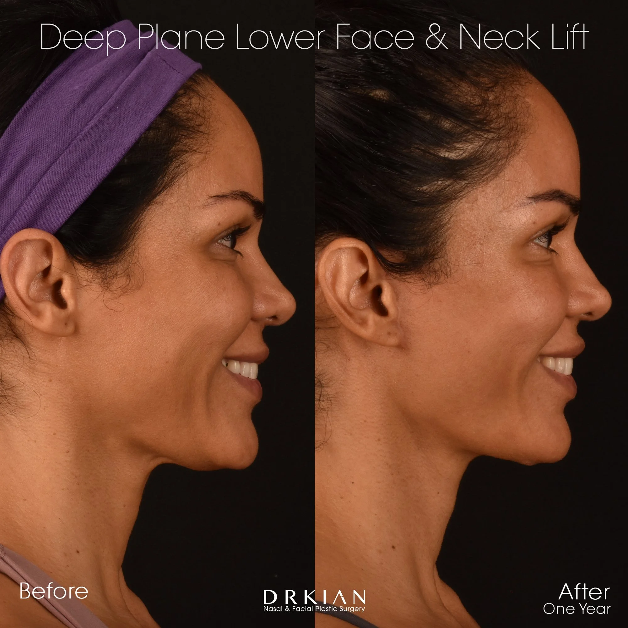 Best facelift results in 40s – patient of Dr. Kian Karimi
