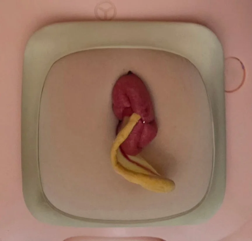 Appendectomy Simulator