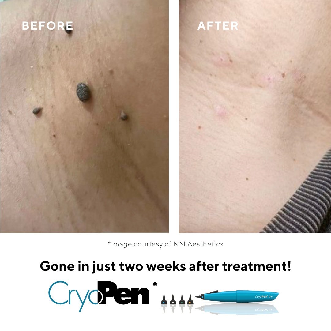 CryoPen Skin Blemish Removal