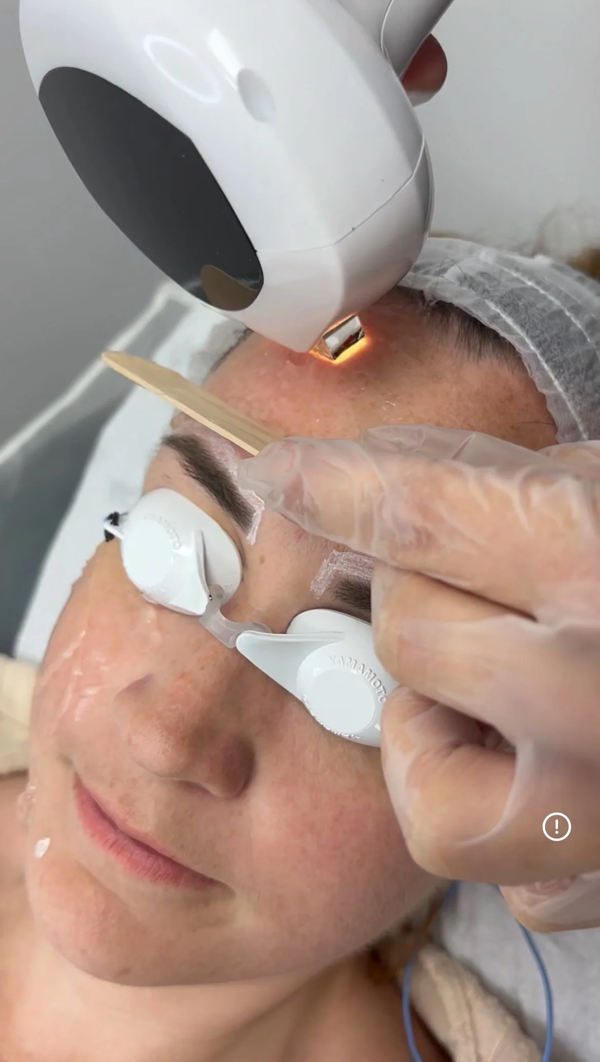 Lumecca IPL Skin Rejuvenation