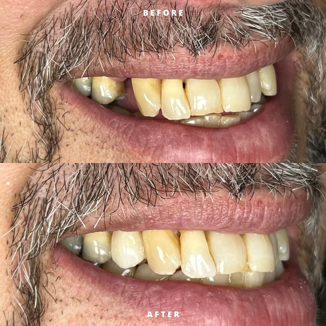 NEW BEFORE AND AFTER bridge.jpg