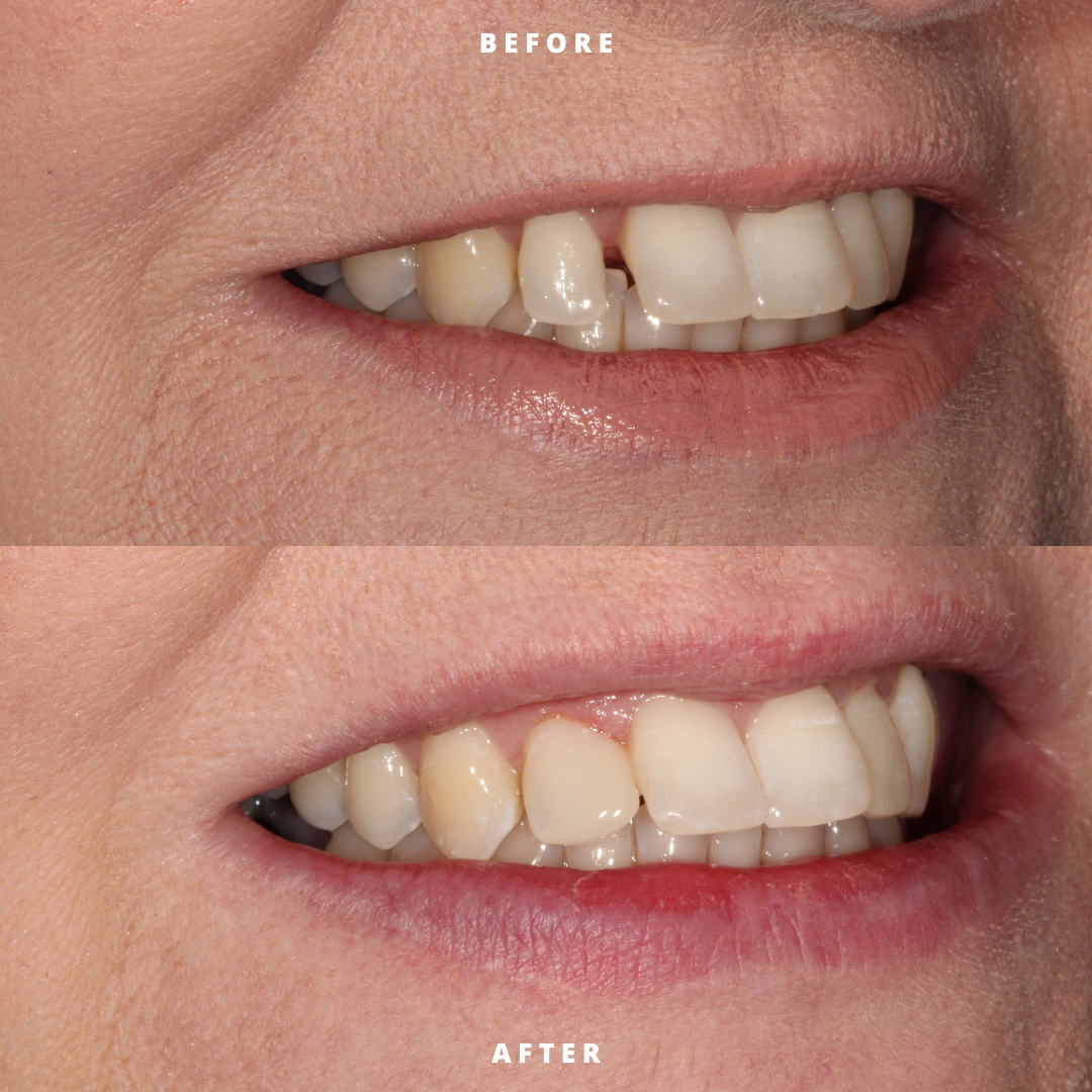 NEW BEFORE AND AFTER  (22).png