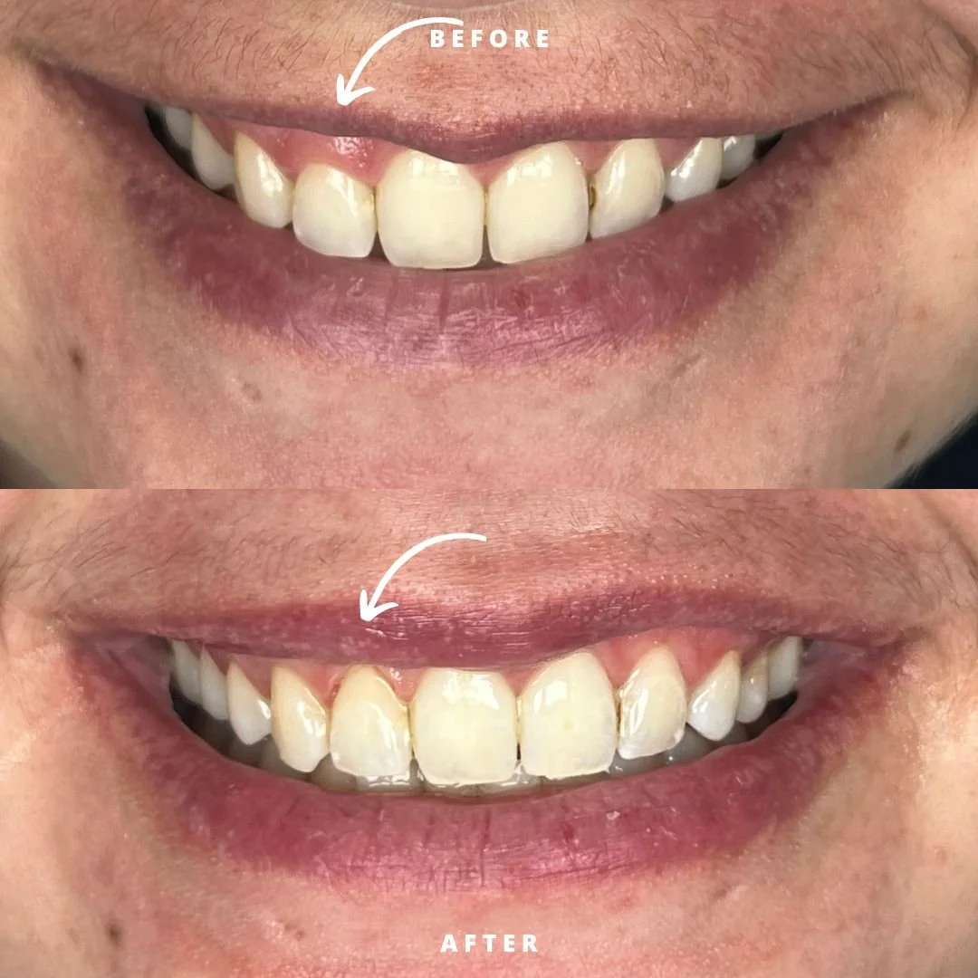 NEW BEFORE AND AFTER  gum contour.jpg