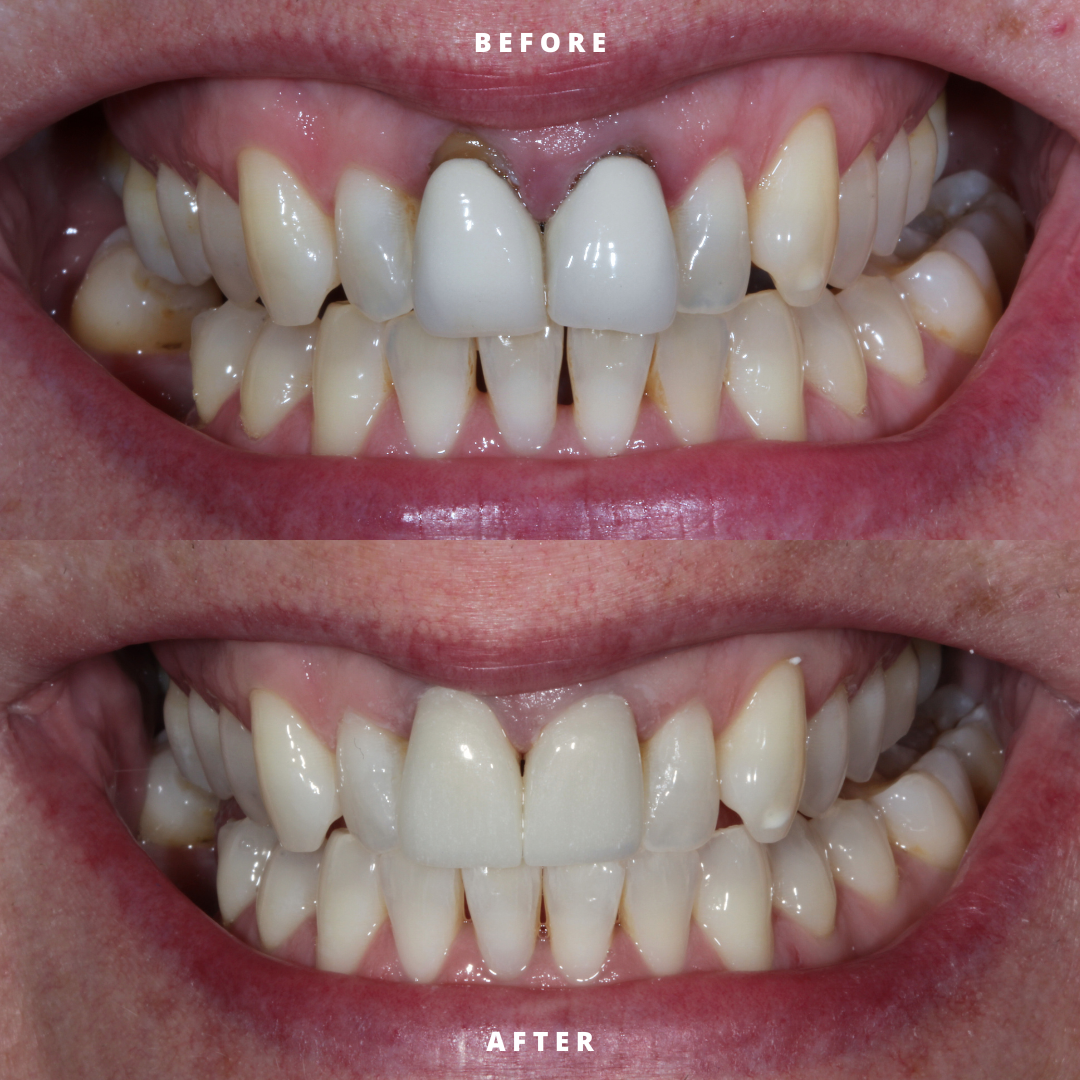 Tooth whitening and replace crowns on upper front teeth
