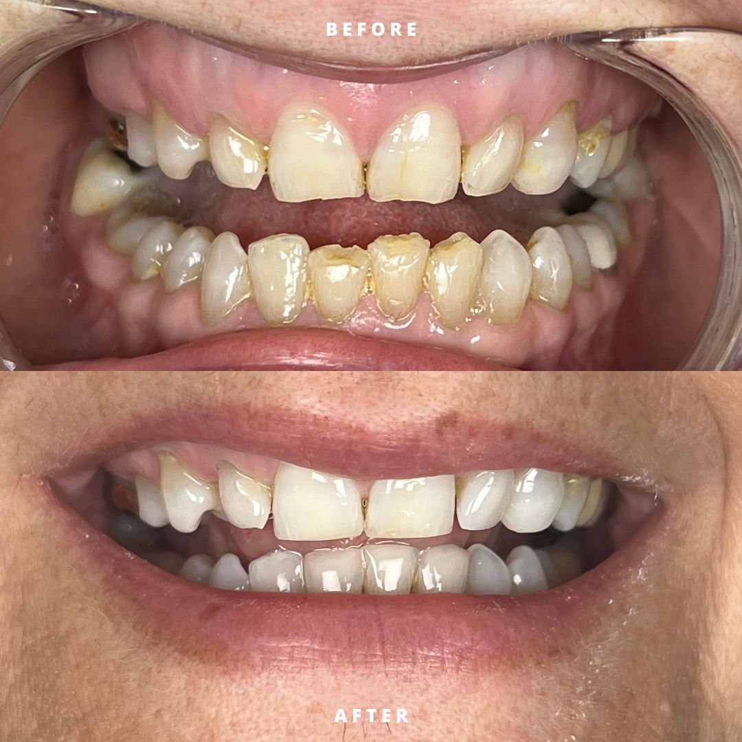 NEW BEFORE AND AFTER  (4).png