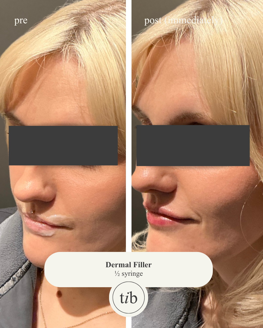 Comparison of a woman's lips before and after using Restylane-L.