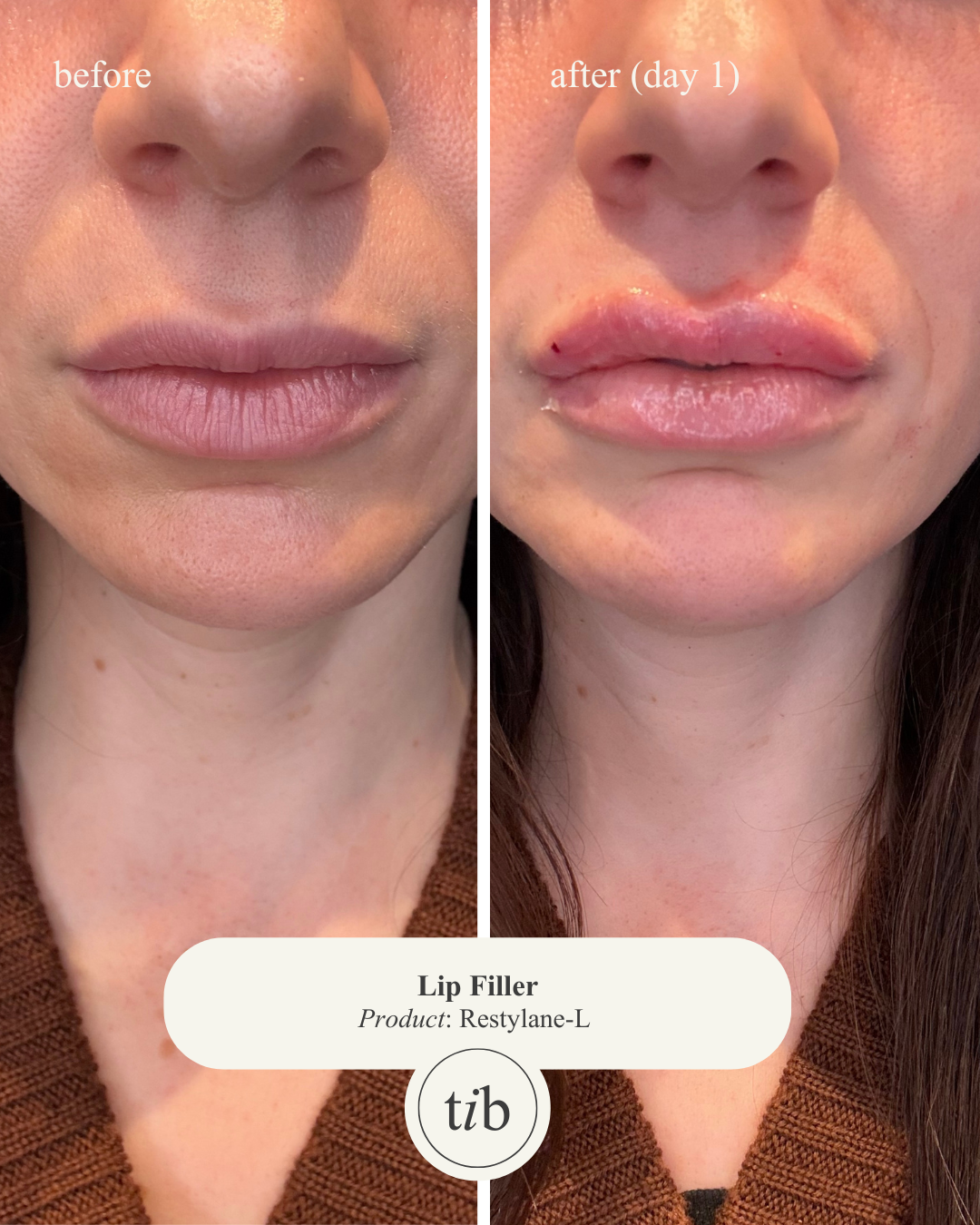 Lip Filler (Before & Day 1 Post).PNG