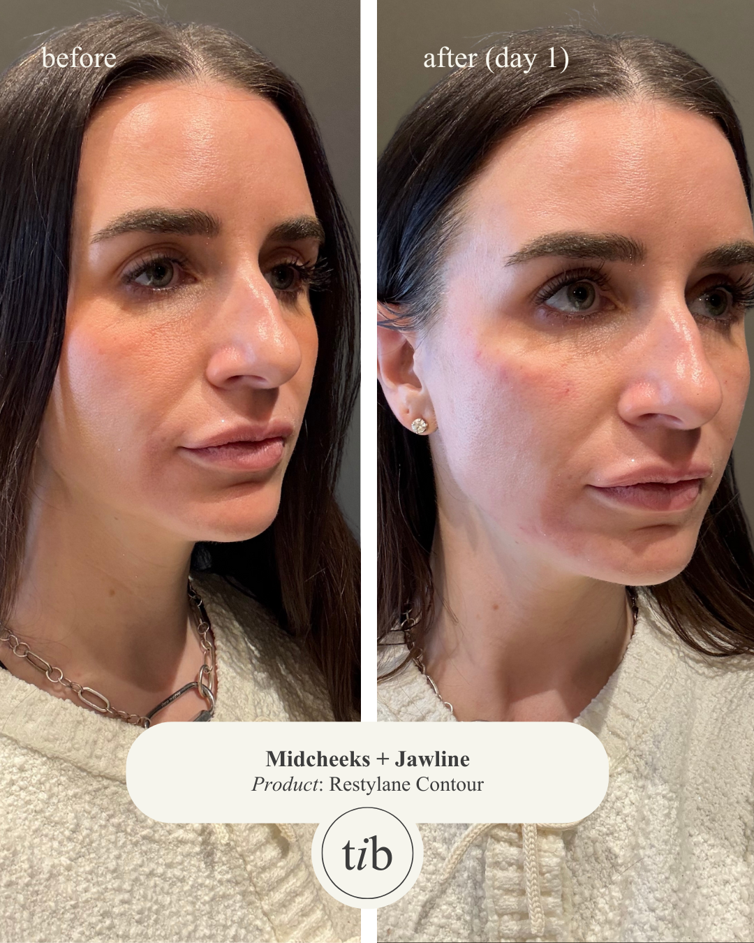 Side-by-side before and after photos of a woman showing the effects of Restylane Contour for mid-cheeks and jawline, with the before image on the left and the after image on the right, labeled 'day 1', with a neutral background and the woman wearing 