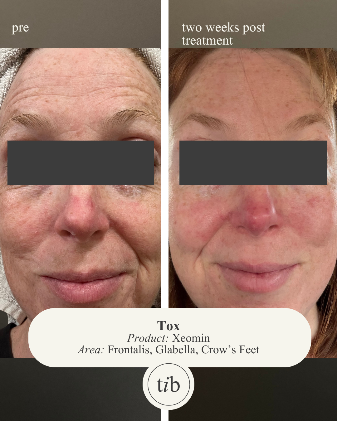 Before and after Xeomin toxin treatment at The Injection Bar in St. Louis — frontalis, glabella, and crow's feet
