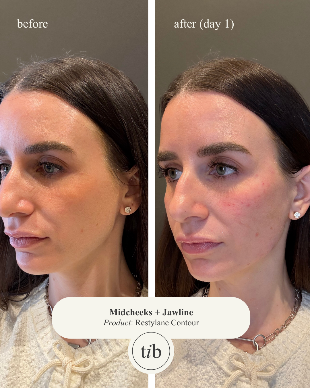 Comparison of a woman's face before and after using Restylane Contour for midcheeks and jawline, showing reduced facial lines and improved contour on the right side.