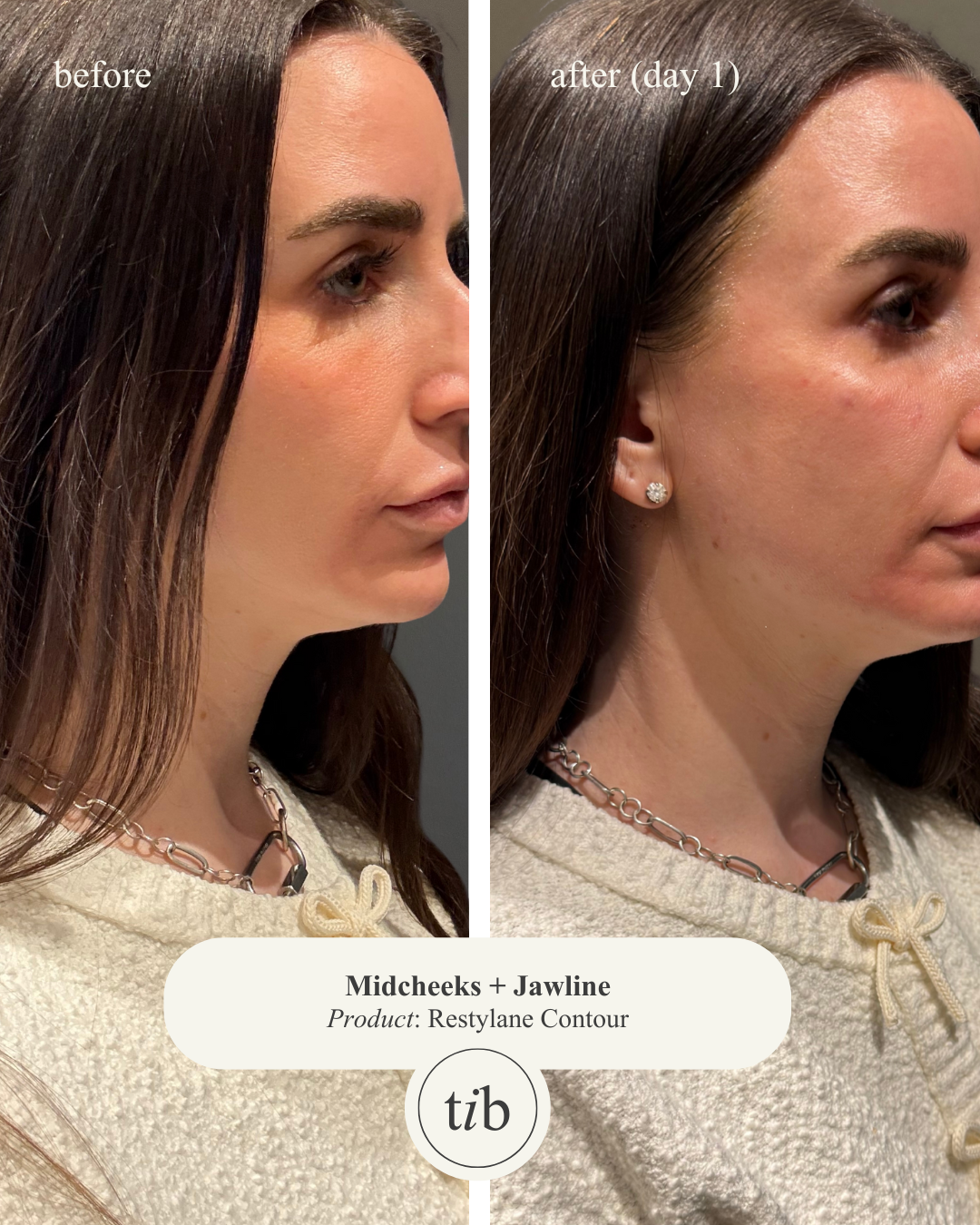 Side-by-side before and after photos of a woman's face. The before photo is on the left, showing her natural skin and facial structure. The after photo on the right, labeled 'day 1,' shows her skin after a Restylane Contour treatment, with noticeable