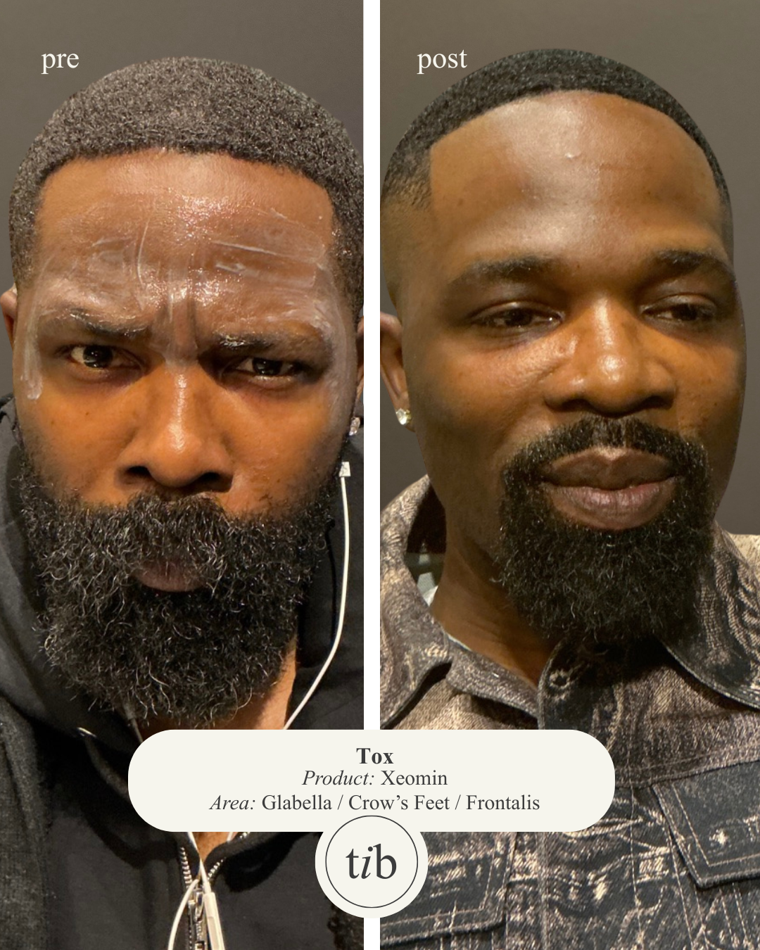 Side-by-side before and after photos of a man, showcasing facial improvements. The before photo shows him furrowing his brow. The after photo shows him with softer facial features. A caption indicates the use of the Xeomin product in the Frontalis ar