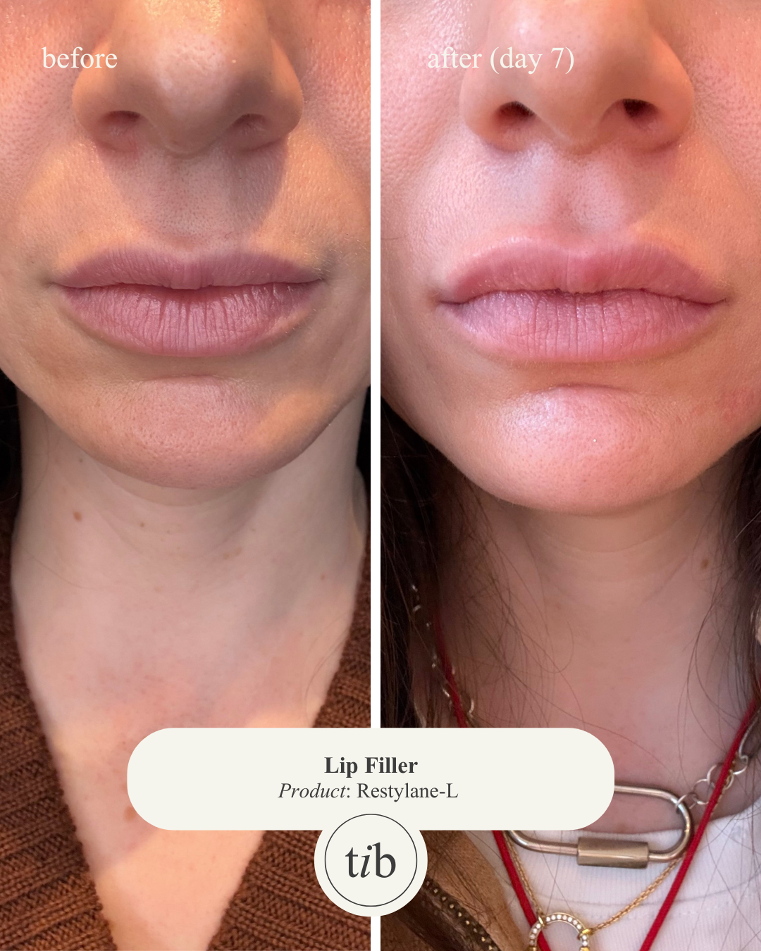 Lip Filler (Before & Day 7 Post).png