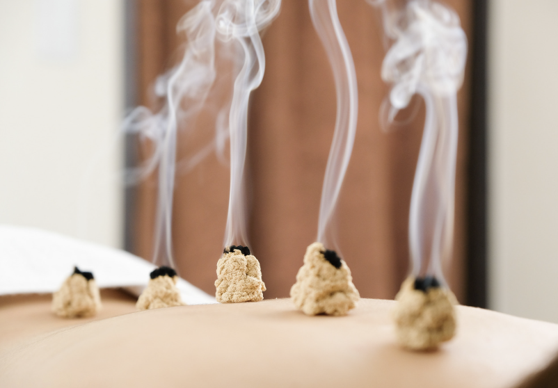 Moxibustion therapy with burning moxa cones on skin
