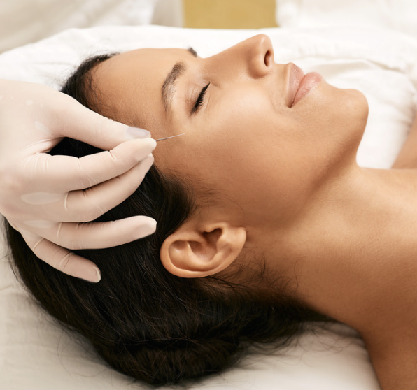 woman receiving acupuncture therapy on face