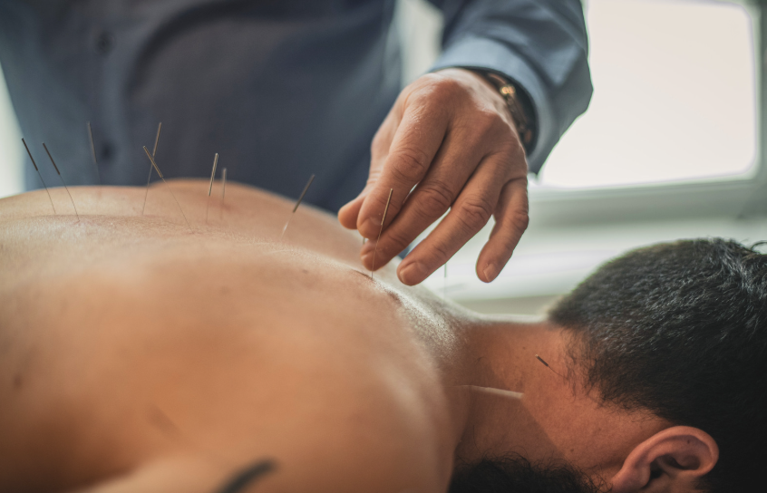 Acupuncture session with needles inserted into a person's back