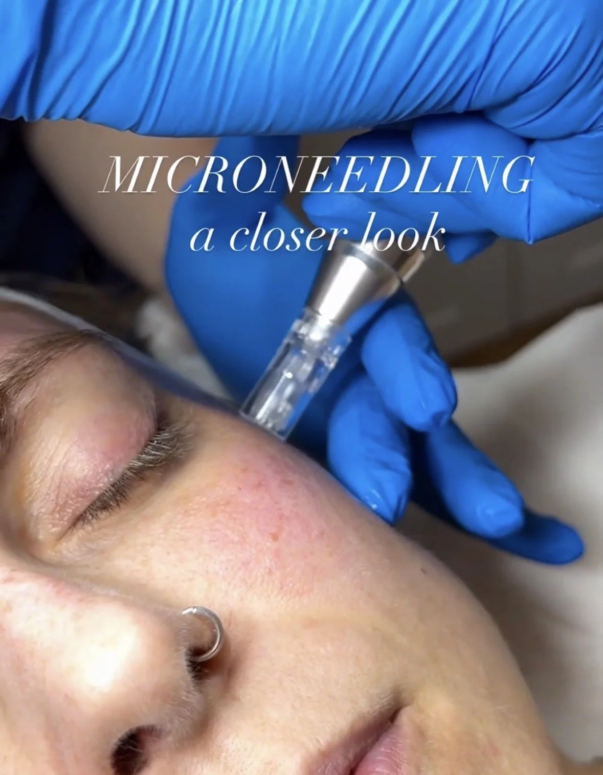 social image of woman getting microneedling done, blue gloves holding silver pen. instagram post cover read: microneedling a closer look