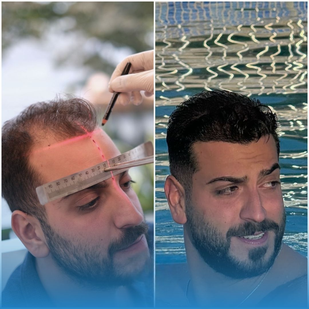Saç Ekimi, FUE Saç Ekimi, DHI Saç Ekimi, Saç Ekimi Türkiye, Doğal Saç Ekimi, Saç Dökülmesi, Saç Ekimi Sonuçları, İstanbul Saç Ekimi, Hair Transplant, FUE Hair Transplant, Hair Transplant Turkey, DHI Hair Transplant, Natural Hair Transplant Results, H