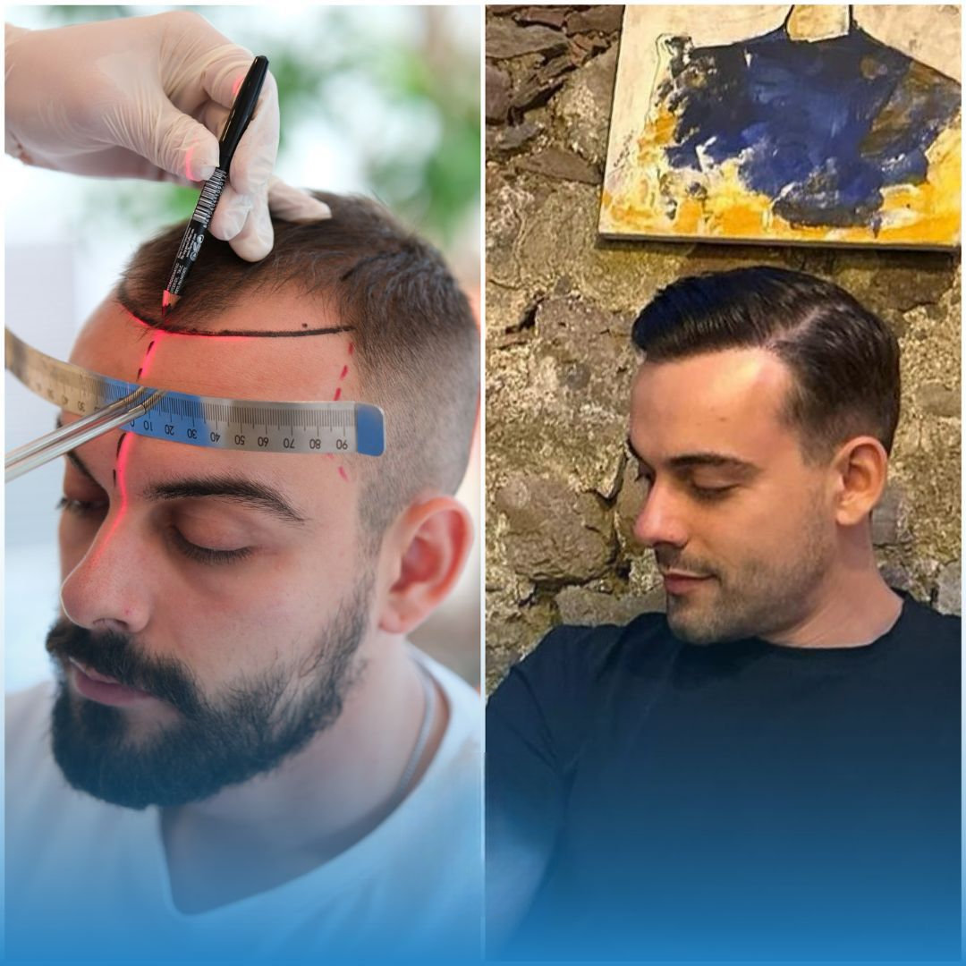 Saç Ekimi, FUE Saç Ekimi, DHI Saç Ekimi, Saç Ekimi Türkiye, Doğal Saç Ekimi, Saç Dökülmesi, Saç Ekimi Sonuçları, İstanbul Saç Ekimi, Hair Transplant, FUE Hair Transplant, Hair Transplant Turkey, DHI Hair Transplant, Natural Hair Transplant Results, H