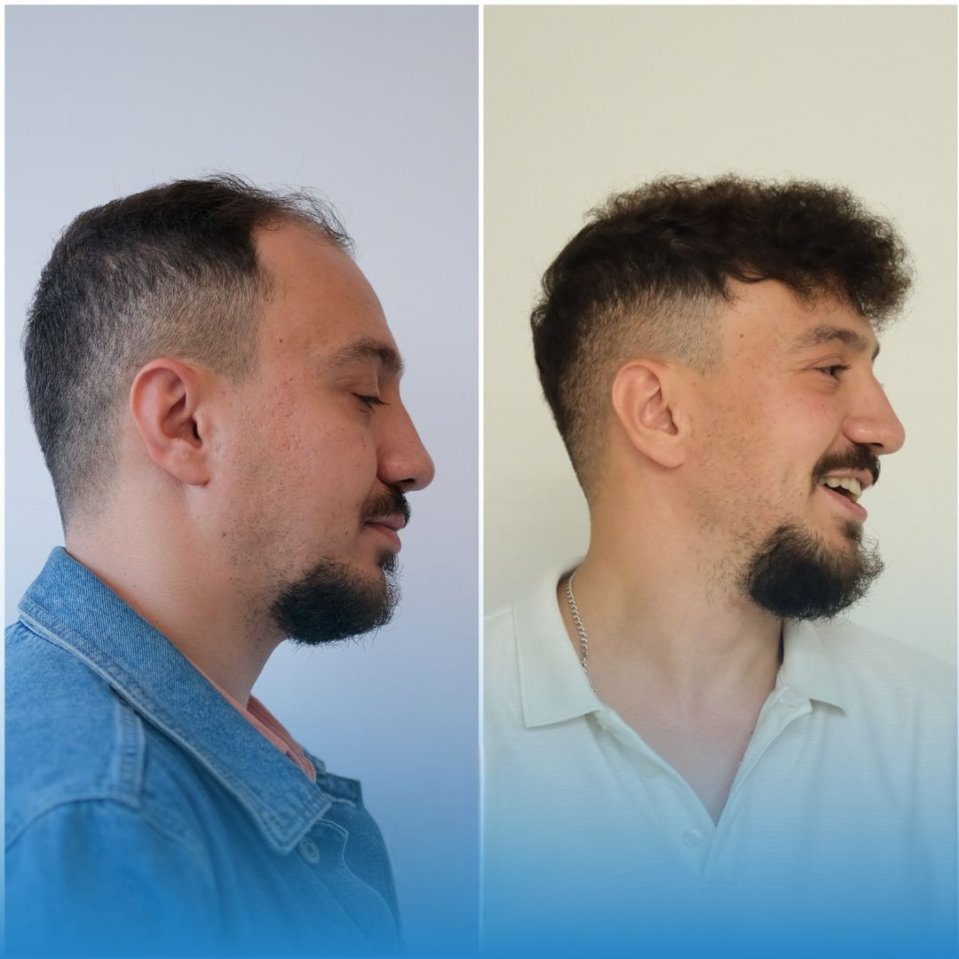 Saç Ekimi, FUE Saç Ekimi, DHI Saç Ekimi, Saç Ekimi Türkiye, Doğal Saç Ekimi, Saç Dökülmesi, Saç Ekimi Sonuçları, İstanbul Saç Ekimi, Hair Transplant, FUE Hair Transplant, Hair Transplant Turkey, DHI Hair Transplant, Natural Hair Transplant Results, H