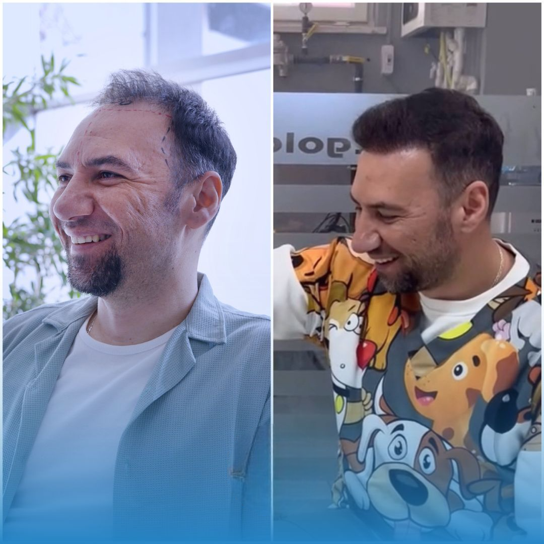Saç Ekimi, FUE Saç Ekimi, DHI Saç Ekimi, Saç Ekimi Türkiye, Doğal Saç Ekimi, Saç Dökülmesi, Saç Ekimi Sonuçları, İstanbul Saç Ekimi, Hair Transplant, FUE Hair Transplant, Hair Transplant Turkey, DHI Hair Transplant, Natural Hair Transplant Results, H